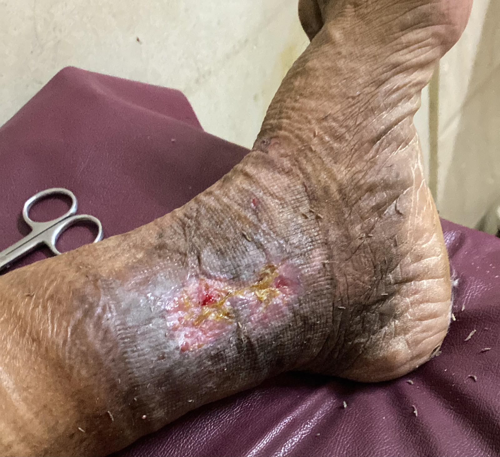 Deep vein thrombosis — Thrombosed vein
