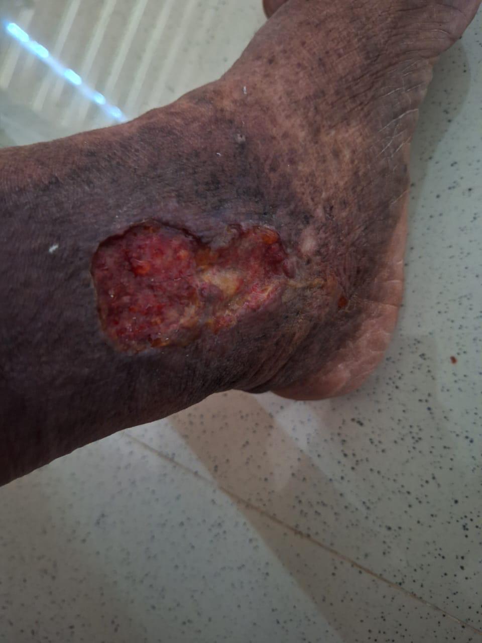 Deep vein thrombosis — Vein recanalised